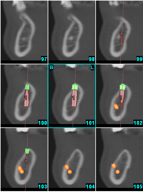 На поперечных срезах видно соотношение виртуально внедренного имплантата и нижнечелюстного нерва. 