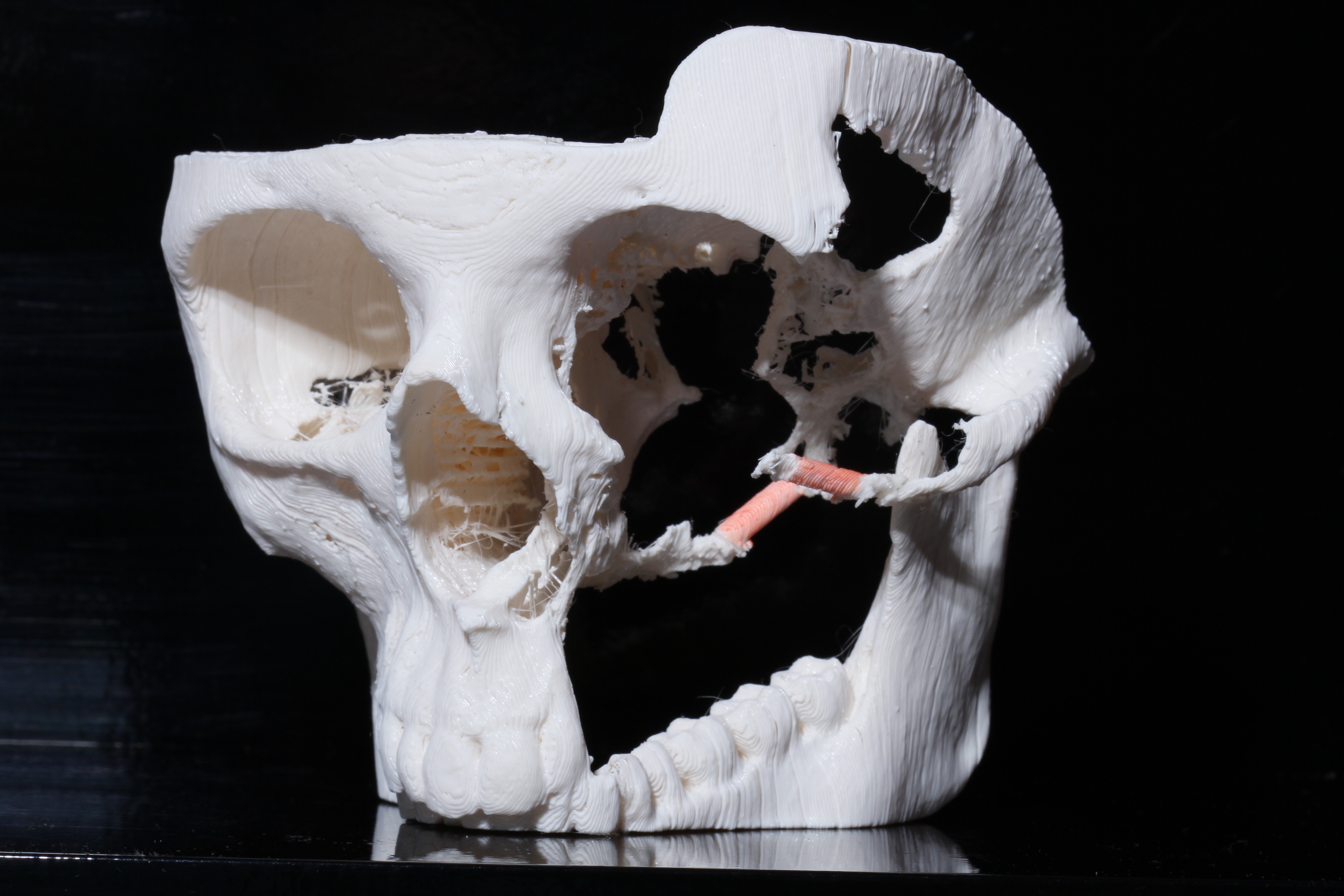 Напечатанная 3D модель пациента