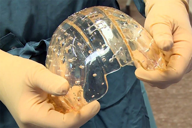Имплантат черепа из специального пластика