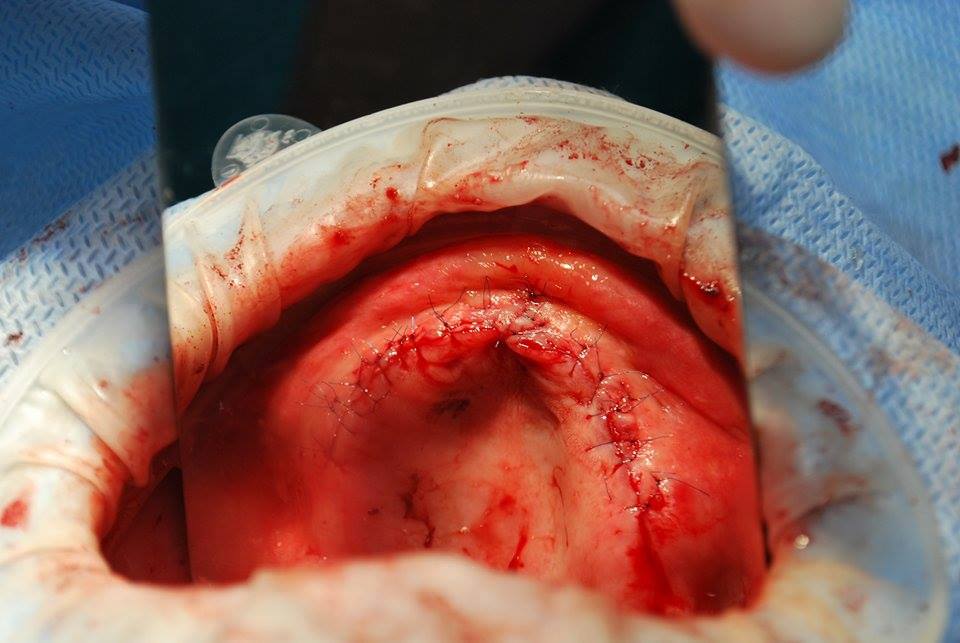 Верхняя челюсть после имплантации