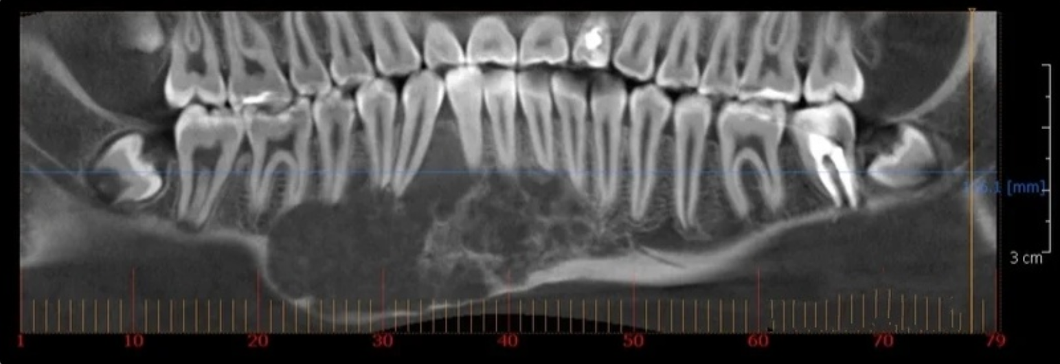 osteoblastoklastoma-1